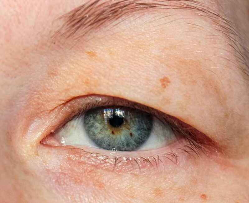 Blepharoplasty