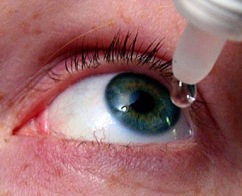 Dry Eye