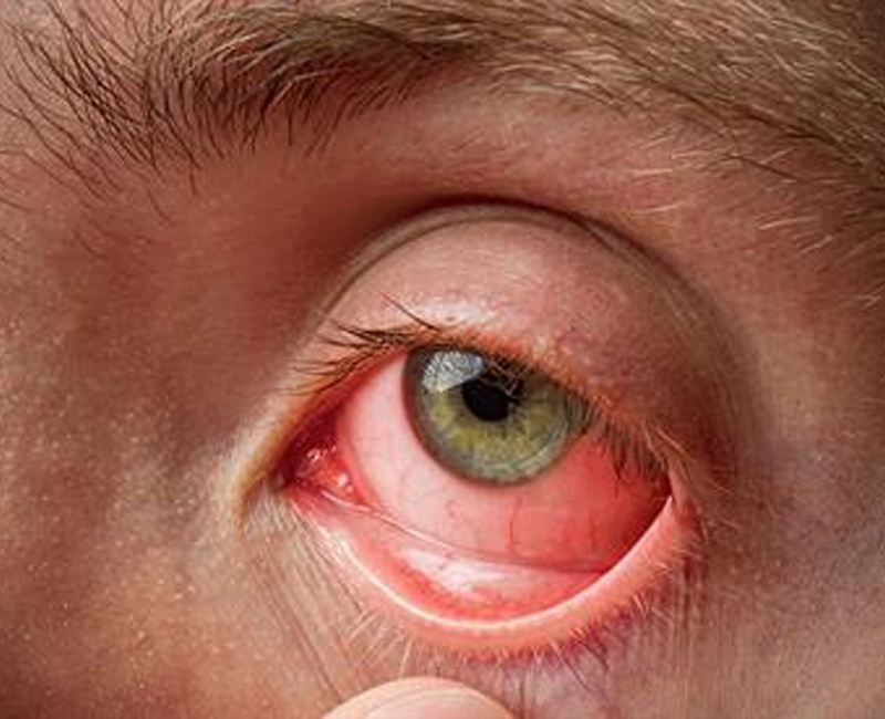 Pink Eye