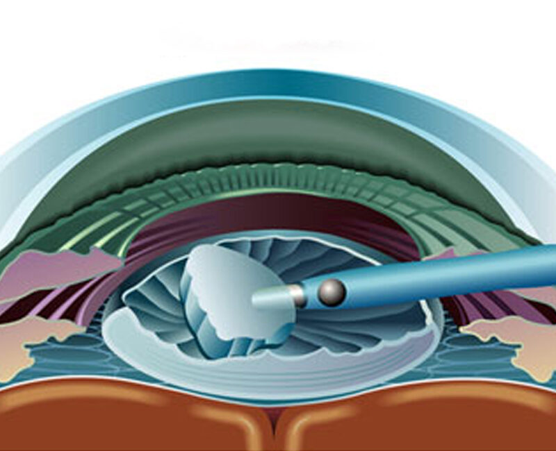 Cataract
