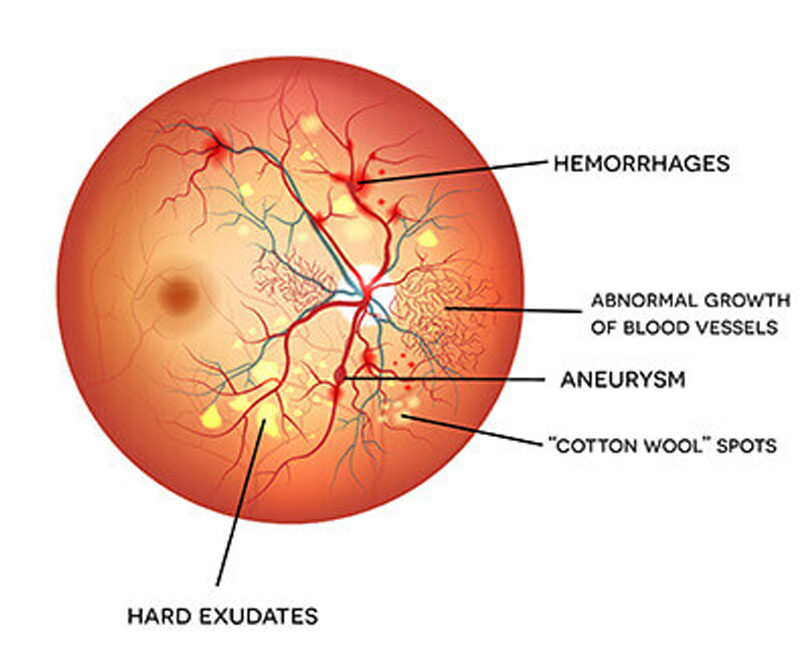 Diabetic Retinopathy