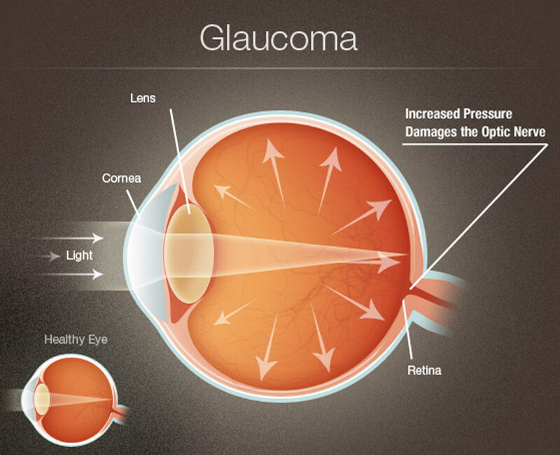 Glaucoma
