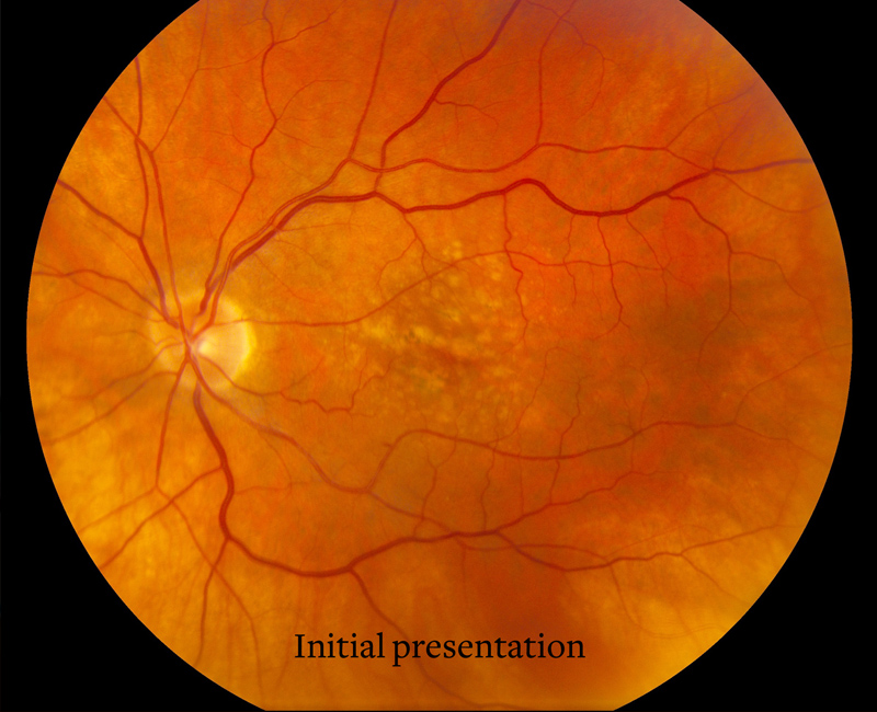 Macular Degeneration
